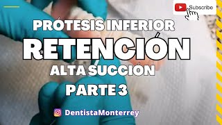 🔥🔥🔥 Prótesis INFERIOR👅ALTA SUCCIÓN Parte3 Resultado [upl. by Tedman]