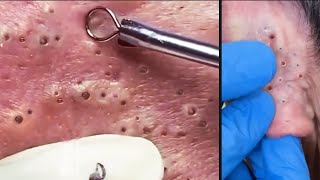 Best Satisfaction and Relaxation Videos 2024  Blackheads Remove  Pimple Remove  Tips amp tricks [upl. by Bradstreet]