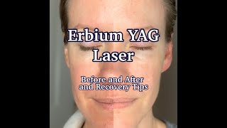 Erbium YAG Laser Treatment  Results and PostCare [upl. by Mac586]