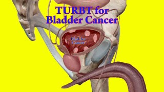 TURBT  How to do Transurethral Resection of Bladder Tumor  Bladder Cancer Surgery [upl. by Odnalref771]