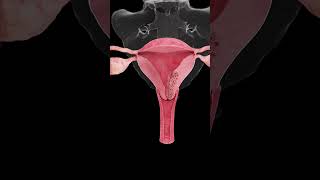 🎗️ Understanding Endometrial Cancer A Growing Concern for Women’s Health 🎗️ [upl. by Nod]