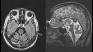 Slurred speech and difficulty walking worse over 6 months [upl. by Nwahsid]