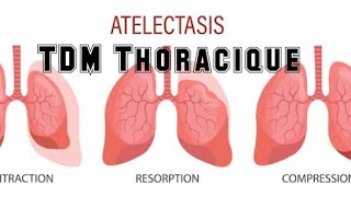 SCANNER THORACIQUE  Foyer d’atélectasie [upl. by Farny]