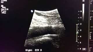 Iliac Vein Duplex Protocol Start to Finish [upl. by Heigho]