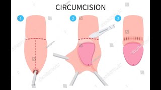 Circumcision Surgery  Step by Step Procedure  Circumcision Animation [upl. by Arul]