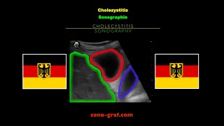 Sonographie  Cholezystitis [upl. by Nilek]