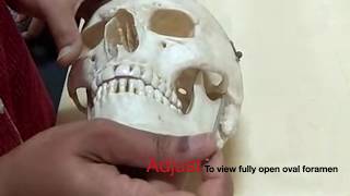 Gasserian ganglion Trigeminal block  made simplified by demo on the skull [upl. by Persson]