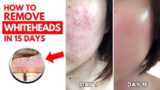 How to remove whiteheads from face at home  Nose whiteheads  whiteheads removal [upl. by Ainavi]