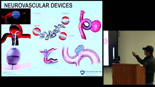 “Intracranial Venous Stenting for Idiopathic Intracranial Hypertension”  Kenneth C Liu MD [upl. by Suhail]