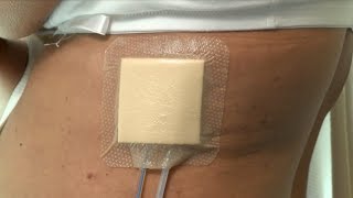 How to care for a postsurgery wound drainage system and Mepilex dressing [upl. by Aeslehs]