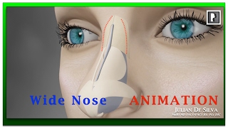 Rhinoplasty Animation  How can a Wide nose be narrowed [upl. by Sulakcin141]