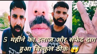 Vitiligo Vlogger 5 महीने में मेरा सफेद दाग हो गया बिल्कुल ठीक जाने कैसे [upl. by Alrac279]