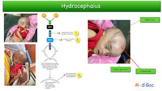 Hydrocephalus baby  Clinical features  Causes  Pathophysiology  Investigations  Treatment [upl. by Elleral]