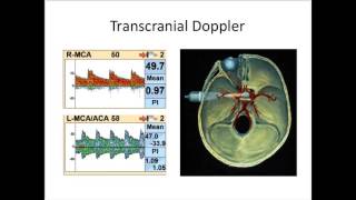 Natus TCD Webinar Performance of the Normal TCD Examination [upl. by Aerdnaek]