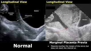 Obstetric Ultrasound Normal Pregnancy Vs Placenta Previa  LowLying Marginal Partial Complete [upl. by Tipton]