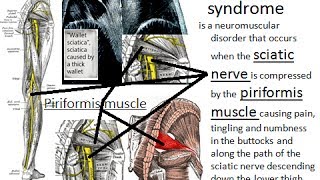 Noninvasive cure of the piriformis syndrome by PNF Copyrights reserved [upl. by Giralda814]