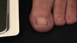 How To Use The NailEase Ingrown Nail Treatment  MYFOOTSHOPCOM [upl. by Alyag]