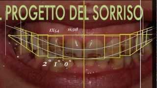 Cambiare laspetto del sorriso con faccette dentali  SMILE DESIGN [upl. by Mikal410]