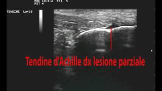 Tendine dAchille dx lesione parziale [upl. by Arrio]