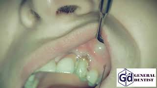 Infiltration anesthesia for treatment tooth 22 [upl. by Prissy]