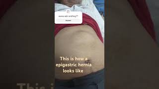 epigastric hernia how it looks on examination [upl. by Anaet302]