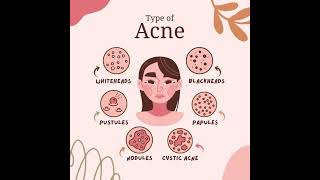 Type Of Acne [upl. by Alberik31]