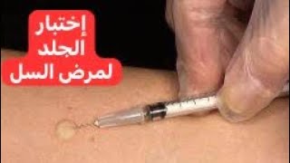 إختبار الجلد لمرض السل Tuberculin Skin Test [upl. by Gally]