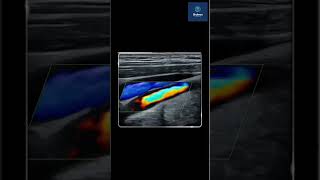 Carotid Doppler Understanding its Importance in Vascular Health [upl. by Auhsohey402]