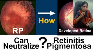 Retinitis Pigmentosa  How she got useful vision  Medical Improvement  DrSasi [upl. by Clementis485]