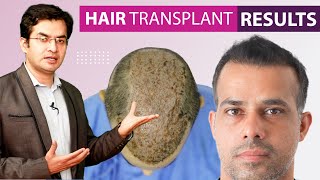 Hair Transplant Before and After Results Grade 6  5000 Grafts at Medispa  Dr Suneet Soni [upl. by Lap726]