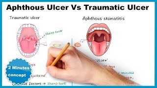 Aphthous ulcerstomatitis Vs Traumatic ulcer [upl. by Soigroeg220]