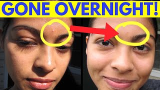 Reduce Pimple Inflammation Overnight [upl. by Mcleroy842]