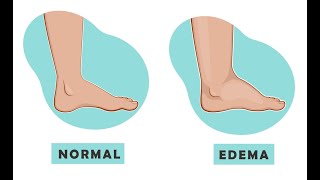 How to take history of swelling if it is the presenting complaint of chief complaint [upl. by Ianteen]