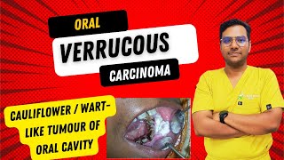 Dr Rudra Mohan  Oral Verrucous CarcinomaCauliflower WartLike Tumour of the Oral Cavity  OVC [upl. by Ydoc]