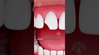 How Does Bonding Fix a Chipped Tooth shorts tooth  Creativelearning3d [upl. by Neneek]