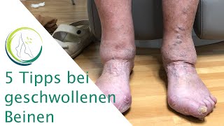 5 Tipps bei Geschwollenen Beinen [upl. by Inafets]