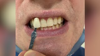 Colgate Optic White whitening system Results Video [upl. by Marsden]