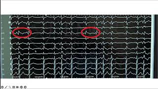 Mitral Annular Disjunction and Arrhythmias [upl. by Adnorrahs520]