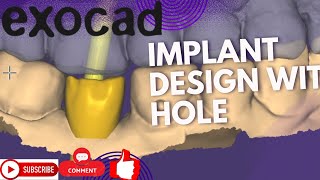 EXOCAD TUTORIAL  HOW TO DESIGN IMPLANT WITH ACCESS HOLE [upl. by Kimberli]