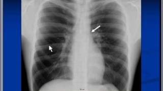 Incomplete border sign for mediastinal masses [upl. by Prima]