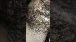 beard hair longer Carly problem beard hairproblem barber barbershop ingrownhair hairremoval [upl. by Enifesoj]