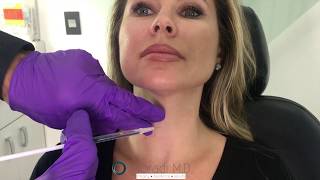 Botox for Neck Bands Platysmal Bands Dr Amir Moradi San Diego California Moradi MD [upl. by Loferski676]