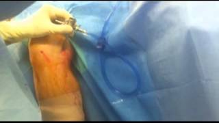 Arthroscopic Excision of Bakers Cyst JF Meyers M D [upl. by Akcimehs]