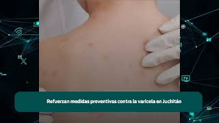 Refuerzan medidas preventivas contra la varicela en Juchitán [upl. by Aineg]