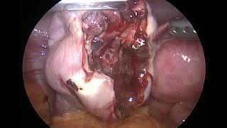 hemorrhagic ovarian cyst [upl. by Sillad]