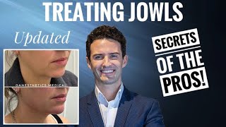 Injectors Guide Treating the jowls with fillers [upl. by Redyr585]