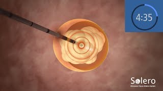 AngioDynamics Solero Microwave Tissue Ablation System Animation [upl. by Blayne]