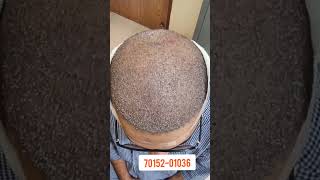 Best full Head HT transform Baldness to hair with Fue technology of baldinghair hairloss Ht Fue [upl. by Elpmid]