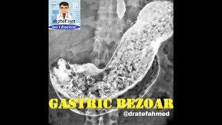 Gastric Bezoar CausesSymptoms and signs Diagnosis Bezoar Removal Endoscopic SurgicalNo1doctor [upl. by Olav870]