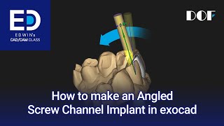 How to Make an Angled Screw Channel Implant in exocad [upl. by Yehudit]